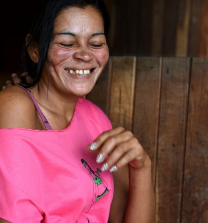 Rosemary, a person affected by leprosy, from Brazil with numb spots on her body due to leprosy complications