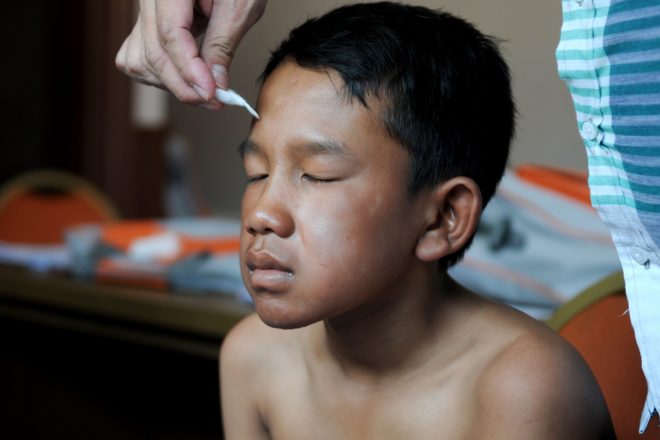 A young boy, affected by leprosy, with senseless spots on his face due to leprosy complications